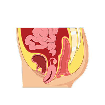 Pelvic floor Repair in Guntur