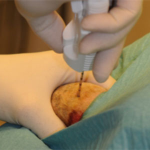 Surgical Sperm Retrieval in Guntur